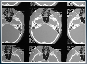 Leading maritime injury lawyer in Boston helping commercial fishermen, merchant seamen and passengers recover the most compensation available after a brain injury happens at sea